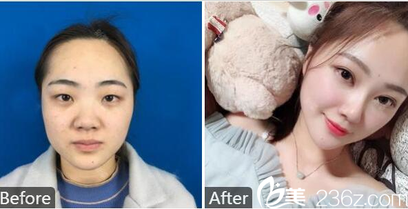 湛江澳泰整形醫(yī)院張維華做的雙眼皮案例 湛江澳泰整形醫(yī)院張維華做的雙眼皮案例