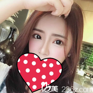 湛江澳泰整形醫(yī)院雙眼皮隆鼻脂肪填充案例圖 湛江澳泰整形醫(yī)院雙眼皮隆鼻脂肪填充案例圖