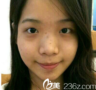 在湛江澳泰整形醫(yī)院做雙眼皮隆鼻手術(shù)前 在湛江澳泰整形醫(yī)院做雙眼皮隆鼻手術(shù)前