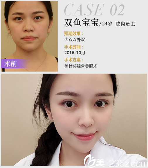 深圳米蘭柏羽年終優(yōu)惠價格表 朱根武美杜莎雙眼皮15600元,王志東隆鼻6800元