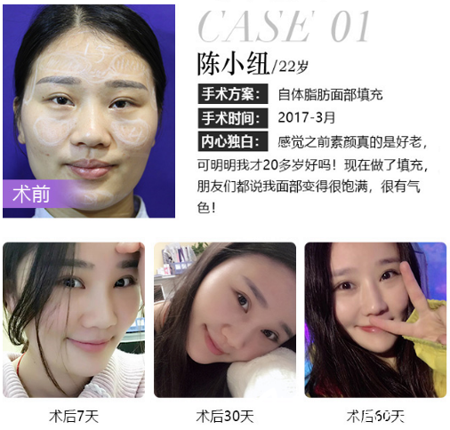 深圳米蘭柏羽王志東醫(yī)生自體脂肪全臉填充案例 深圳米蘭柏羽王志東醫(yī)生自體脂肪全臉填充案例