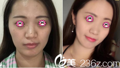 北京華韓柳民熙面部提升