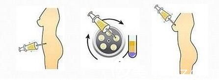 自體脂肪移植 自體脂肪移植