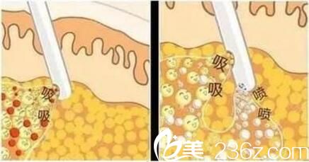 自體脂肪移植優(yōu)勢(shì) 自體脂肪移植優(yōu)勢(shì)