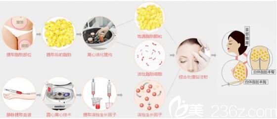 自體脂肪移植選哪些部位的脂肪比較好 自體脂肪移植選哪些部位的脂肪比較好