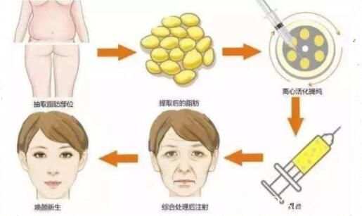 自體脂肪移植后怎么保養(yǎng)呢? 自體脂肪移植后怎么保養(yǎng)呢?