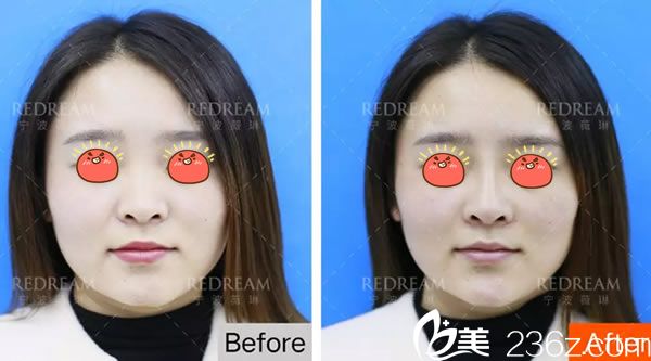 寧波薇琳曾舉公主玻尿酸注射<span style=