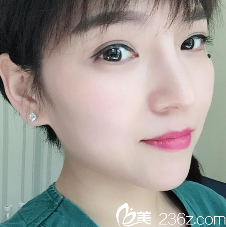 深圳米蘭柏羽劉俊醫(yī)生晶鉆隆鼻案例