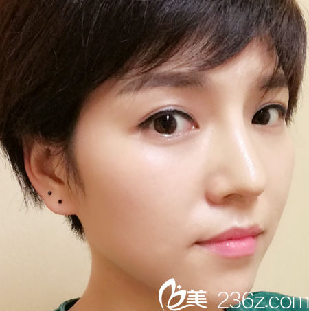 深圳隆鼻哪家好？看我找深圳米蘭柏羽劉俊醫(yī)生做的晶鉆隆鼻案例就知道