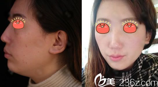 寧波薇琳王春娟玻尿酸墊下巴案例 寧波薇琳王春娟玻尿酸墊下巴案例