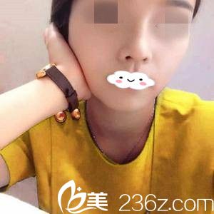 隆鼻半個(gè)月 隆鼻半個(gè)月