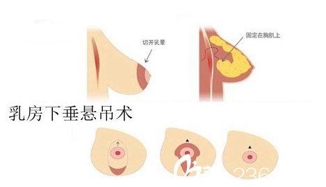 乳房下垂矯正提升術(shù)