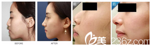 注射玻尿酸隆鼻案例