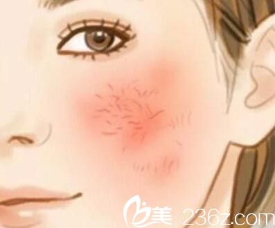 紅血絲形成的原因