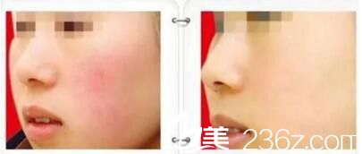 激光去紅血絲前后效果對比