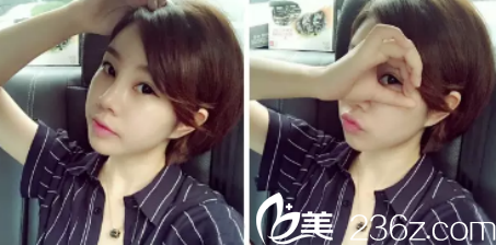 距離我在西安做埋線雙眼皮+玻尿酸隆鼻差不多90天了，感覺(jué)不錯(cuò)