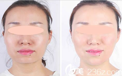 唐山蘇亞美聯(lián)臣面部輪廓效果對(duì)比圖 唐山蘇亞美聯(lián)臣面部輪廓效果對(duì)比圖