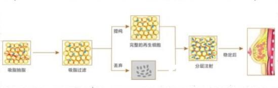 瘦人做自體脂肪隆胸會(huì)不會(huì)成活率低