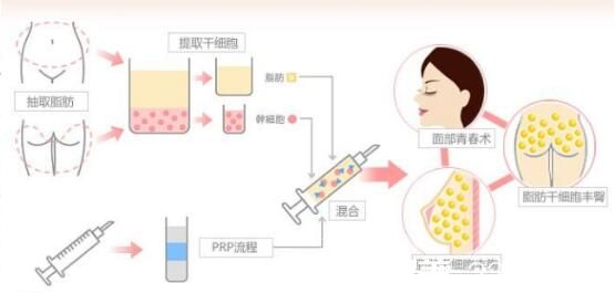  自體脂肪吸收率好不好？