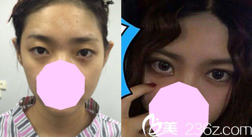 蚌埠國色整形醫(yī)院好嗎？程新德無痕雙眼皮案例來驗證