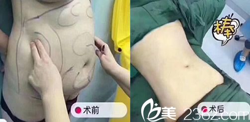 朱寶玉腰部環(huán)吸術(shù)后即刻對比圖
