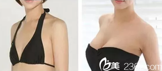 <!--<i data=20240703-sp></i>-->魯天宇隆胸怎么樣