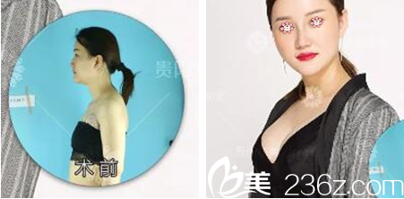 貴陽華美韓盛斌隆胸好不好