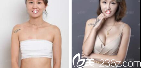 <!--<i data=20240703-sp></i>-->張衛(wèi)衛(wèi)隆胸怎么樣