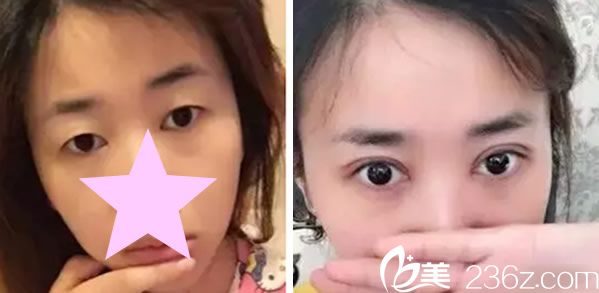 鄭州芳藝整形美容醫(yī)院全切雙眼皮代表案例 鄭州芳藝整形美容醫(yī)院全切雙眼皮代表案例