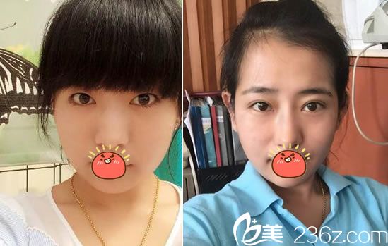 <!--<i data=20240703-sp></i>-->孫菊妹雙眼皮和隆鼻<span style= <!--<i data=20240703-sp></i>-->孫菊妹雙眼皮和隆鼻<span style=