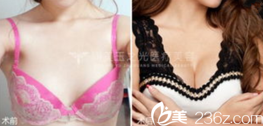 王明利自體脂肪豐胸案例