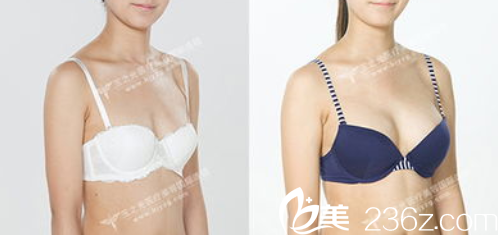 王明利假體隆胸案例