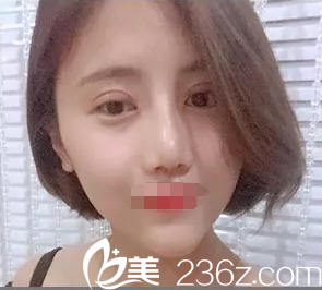 一周拆線眼鼻恢復(fù)中 一周拆線眼鼻恢復(fù)中