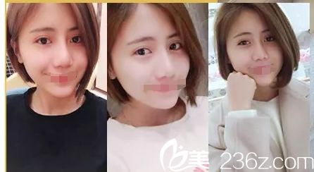 趁張讓虎醫(yī)生坐診南通康美期間面診做了雙眼皮+假體隆鼻 甩掉肌無力的三角眼和塌鼻根