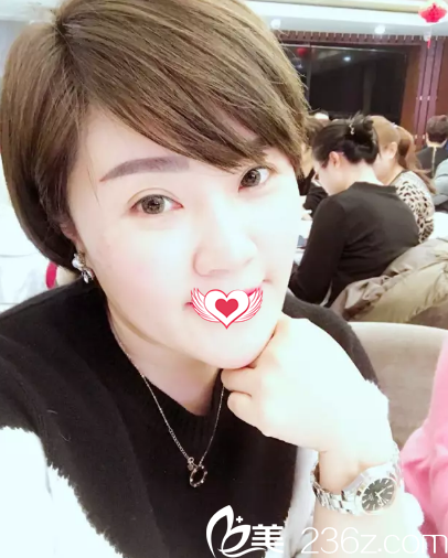 秦皇島巧致員工親測線雕提拉效果 術后30歲還可以像18歲那樣年輕