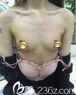 重慶軍科整形JK內(nèi)窺鏡全感豐胸術(shù) 重慶軍科整形JK內(nèi)窺鏡全感豐胸術(shù)