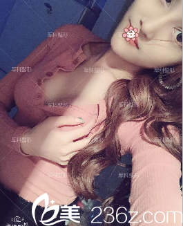 重慶軍科趙亞均假體隆胸術(shù)后一個月 重慶軍科趙亞均假體隆胸術(shù)后一個月