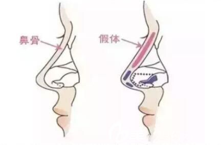 硅膠隆鼻副作用一：鼻形不美觀