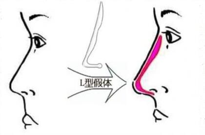 硅膠隆鼻副作用二：手術(shù)后存在假體不穩(wěn)定