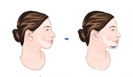 什么是下巴整形手術(shù)？