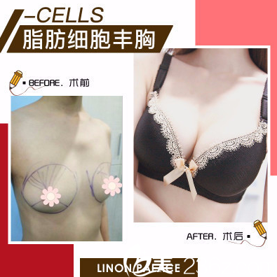 東莞維多利亞整形醫(yī)院隆胸效果圖 東莞維多利亞整形醫(yī)院隆胸效果圖