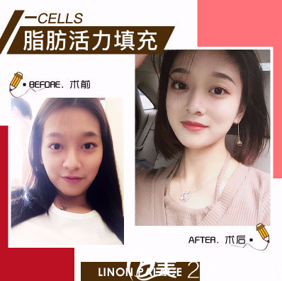 東莞維多利亞面部脂肪填充效果圖 東莞維多利亞面部脂肪填充效果圖