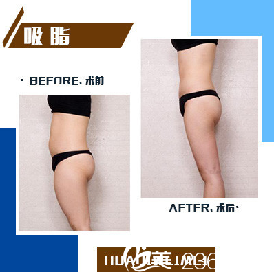 東莞維多利亞吸脂效果圖 東莞維多利亞吸脂效果圖