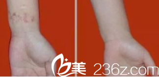 北京米蘭柏羽麗都去疤實例參考