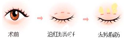韓式重瞼術(shù)手術(shù)方法圖解