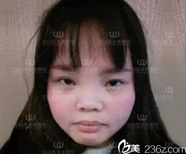 在杭州連天美做鼻綜合前 在杭州連天美做鼻綜合前