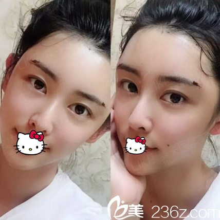 面部脂肪填充術(shù)后2天恢復情況 面部脂肪填充術(shù)后2天恢復情況