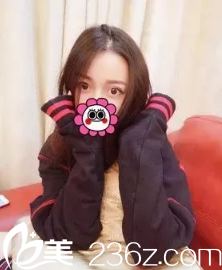 大家都很喜歡我在滄州靜港做的自然雙眼皮效果 更贊的是術(shù)后不會(huì)出現(xiàn)又假又腫的肉條狀