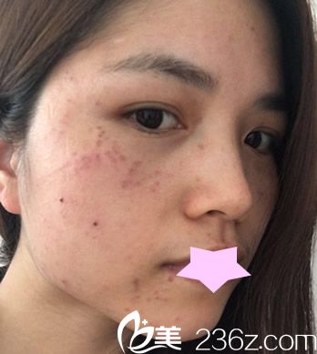 找合肥華美王榮堂做皮秒祛斑后即刻照片 找合肥華美王榮堂做皮秒祛斑后即刻照片