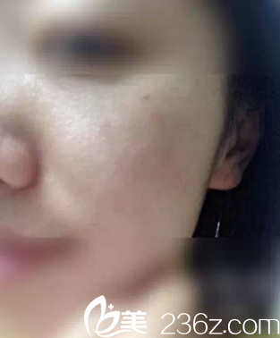 在做皮秒祛斑12天讓我擺脫遺傳雀斑 輕松擁有光滑潔白肌膚